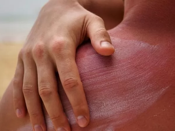 Índice UV alcanza nivel extremo en todo el país: alerta máxima para la salud