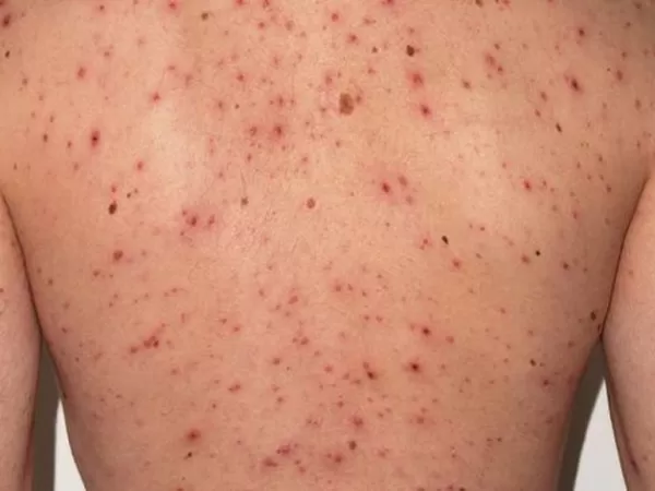 Activan una alerta epidemiol&oacute;gica por sarampi&oacute;n