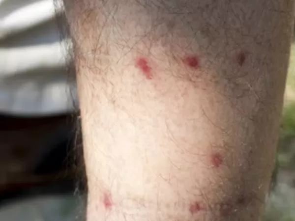 Invasi&oacute;n de barig&uuml;&iacute; en Buenos Aires: qu&eacute; hacer frente a la mordedura de este insecto