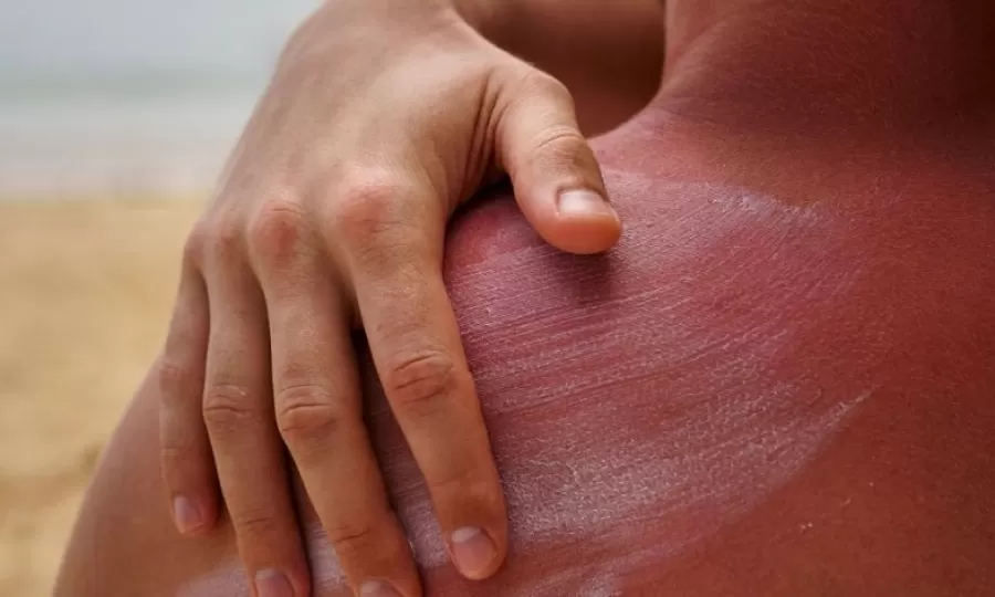 Índice UV alcanza nivel extremo en todo el país: alerta máxima para la salud