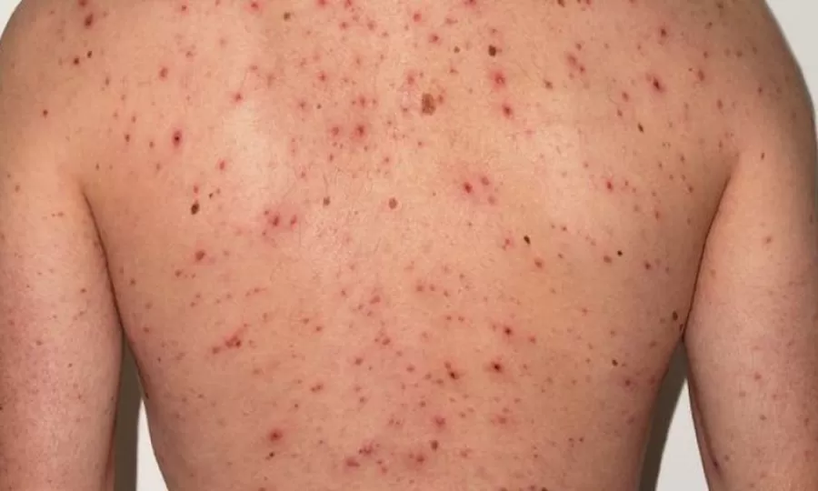 Activan una alerta epidemiol&oacute;gica por sarampi&oacute;n