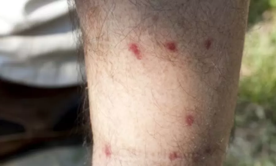 Invasi&oacute;n de barig&uuml;&iacute; en Buenos Aires: qu&eacute; hacer frente a la mordedura de este insecto