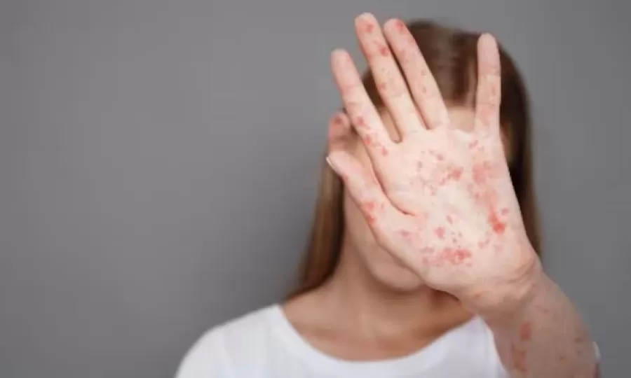 Alerta epidemiológica por sarampión en Argentina: se confirmaron cuatro casos en personas que viajaron por varias provincias